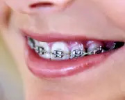 alinhamento-dentario-e-aparelhos-odontologicos-5