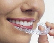alinhamento-dentario-e-aparelhos-odontologicos-6