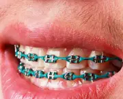 alinhamento-dentario-e-aparelhos-odontologicos-7