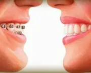 alinhamento-dentario-e-aparelhos-odontologicos-2