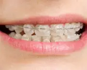 alinhamento-dentario-e-aparelhos-odontologicos-3