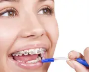 alinhamento-dentario-e-aparelhos-odontologicos-8