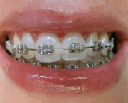 alinhamento-dentario-e-aparelhos-odontologicos-9