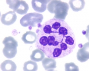 Anemia Megaloblástica Patogenia (1)