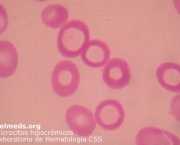 Anemia Megaloblástica Patogenia (2)