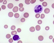 Anemia Megaloblástica Patogenia (8)