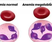 Anemia Megaloblástica Patogenia (10)