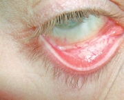 Anemia Megaloblástica Patogenia (13)