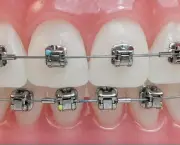 aparelho-ortodontico-autoligado-adulto.jpg