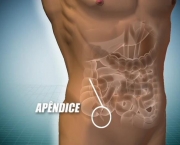 Sintomas-da-apendicite.jpg