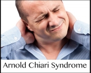 Arnold-Chiari-Syndrome-.jpg