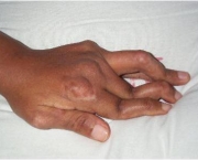 Como é a Artrite Reumatoide (3)