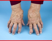 Como é a Artrite Reumatoide (4)