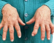 Como é a Artrite Reumatoide (5)