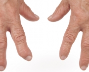 Old Woman's Hands Deformed From Rheumatoid Arthritis