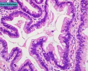 Atrofia Glandular e Metaplasia Intestinal (3)
