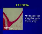 Atrofia Glandular e Metaplasia Intestinal (6)