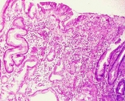 Atrofia Glandular e Metaplasia Intestinal (13)