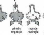 foto-bronquiectasia-11