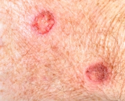 Carcinoma de Células Escamosas da Pele (1)