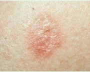 Carcinoma de Células Escamosas da Pele (2)