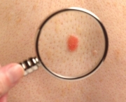 Carcinoma de Células Escamosas da Pele (3)