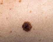 Carcinoma de Células Escamosas da Pele (5)
