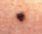 Carcinoma de Células Escamosas da Pele (7)