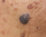 Carcinoma de Células Escamosas da Pele (10)