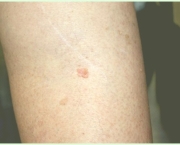 Carcinoma de Células Escamosas da Pele (11)