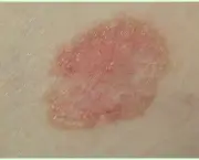 Carcinoma de Células Escamosas da Pele (12)
