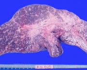Cirrose Hepática (2)