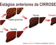 Cirrose Hepática (7)