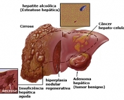 Cirrose Hepática (8)