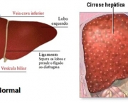 Cirrose Hepática (9)