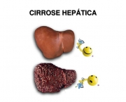 Cirrose Hepática (11)