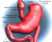 Cirurgia Bariátrica x Dependência de Álcool (1)