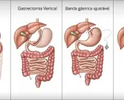 Cirurgia Bariátrica x Dependência de Álcool (5)