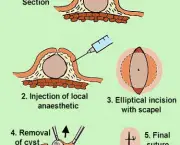 Sebaceous-Cyst-removal.jpg