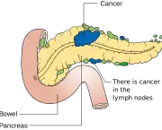 Diagram_showing_pancreatic_cancer_in_the_lymph_nodes_(N_staging)_CRUK_178.svg.png