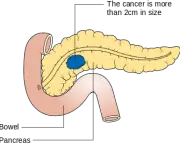 Diagram_showing_stage_T2_cancer_of_the_pancreas_CRUK_254.svg.png