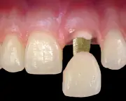 Como é Feita a Prótese Dentária (1)