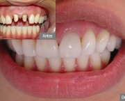 Como é Feita a Prótese Dentária (6)