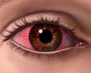 Como Tratar Coceira nos Olhos Causada por Alergias (6)