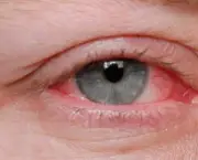 Como Tratar Coceira nos Olhos Causada por Alergias (14)