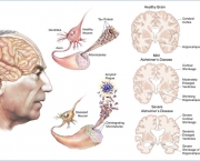 demencia-senil-a-doenca-de-alzheimer-5