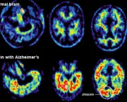 demencia-senil-a-doenca-de-alzheimer-4
