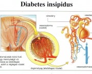 Diabetes Insipidus (9).jpg