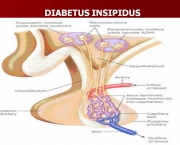 Diabetes Insipidus (13).JPG