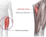 Distensão Muscular da Virilha (4)